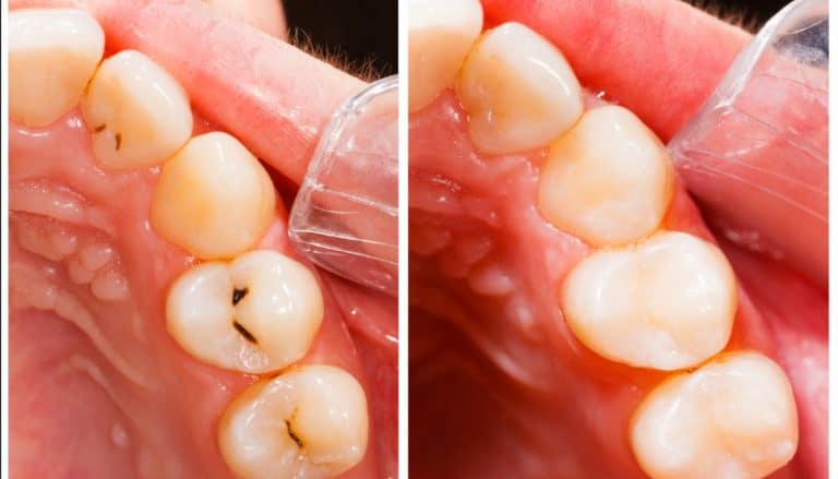 Tooth-coloured dental fillings in Leeds