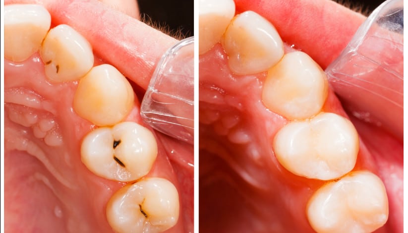 fillings