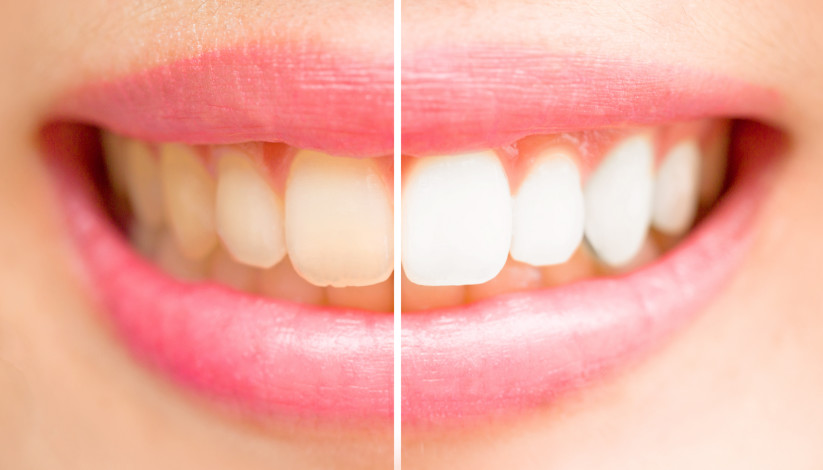 teeth-whitening