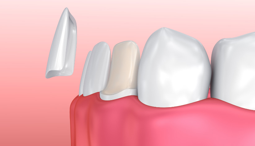 veneers