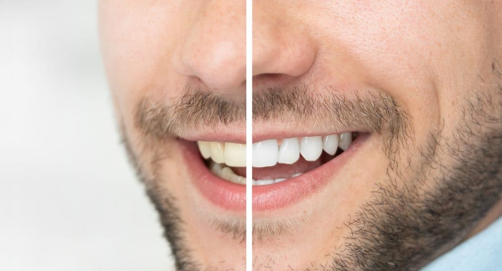 Teeth whitening in Leeds – a smile before and after whitening