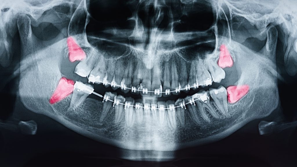 Gentle tooth extraction at The Tooth Spa in Chapel Allerton