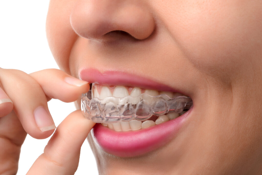 Invisalign Leeds – patient fitting a clear Invisalign aligner, available from our private dentist in Leeds