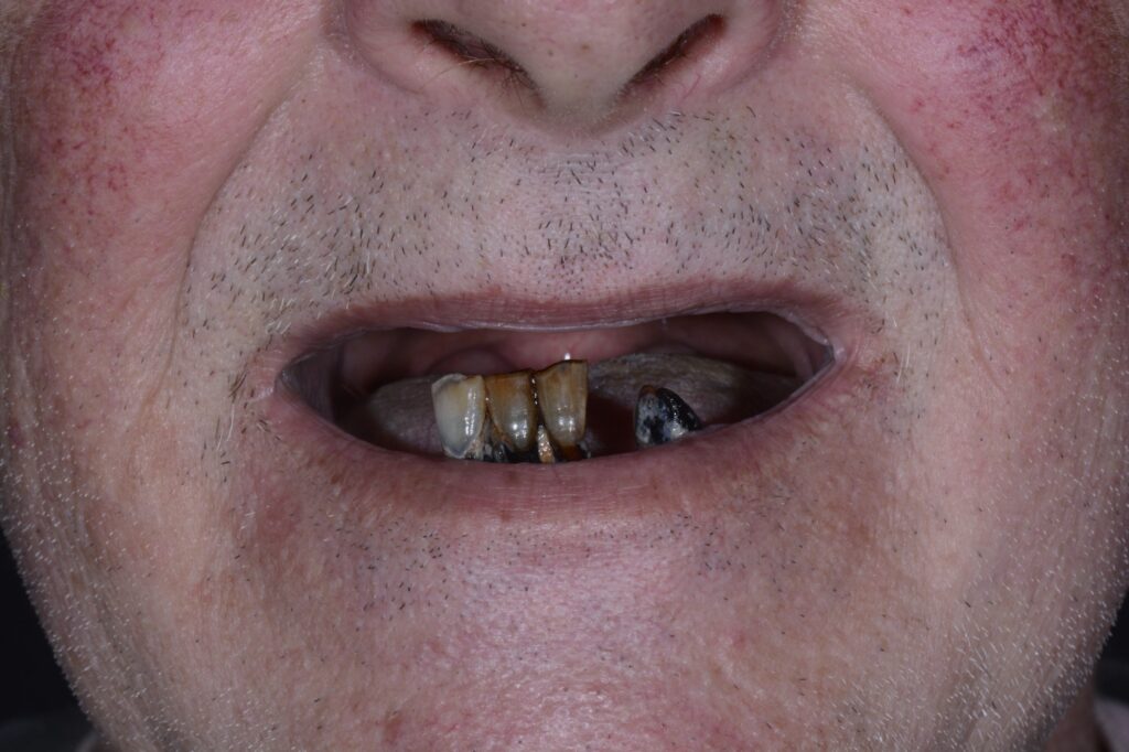 Before: Worn and missing teeth replaced