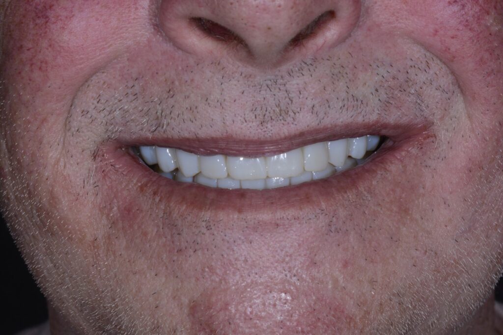 After: Worn and missing teeth replaced at The Tooth Spa