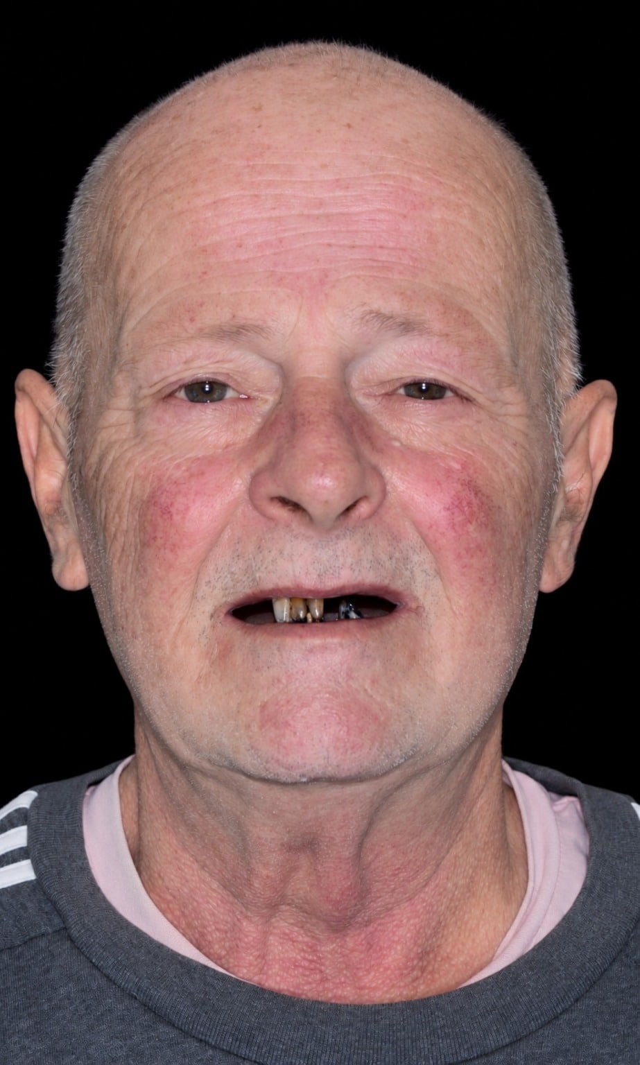 Before: worn and missing teeth
