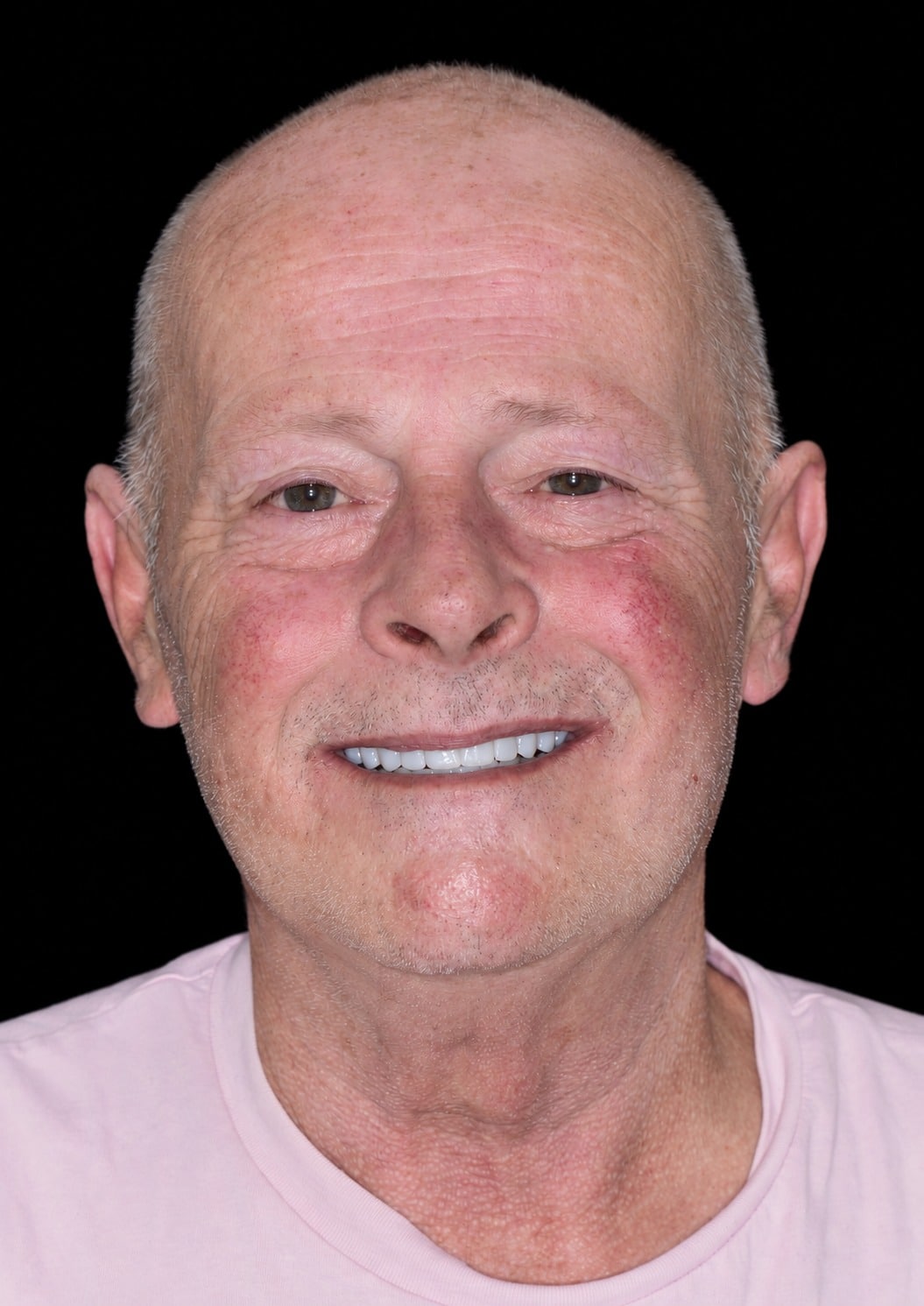 After: full smile makeover at The Tooth Spa, Leeds