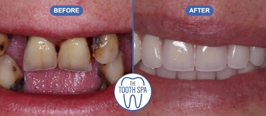 Dental implants before and after: full smile restored at The Tooth Spa, Leeds