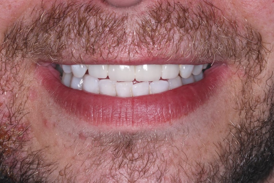 After: Full new smile at The Tooth Spa