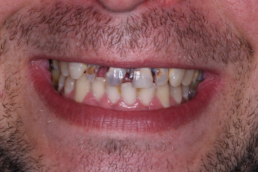 Before: Worn and broken teeth