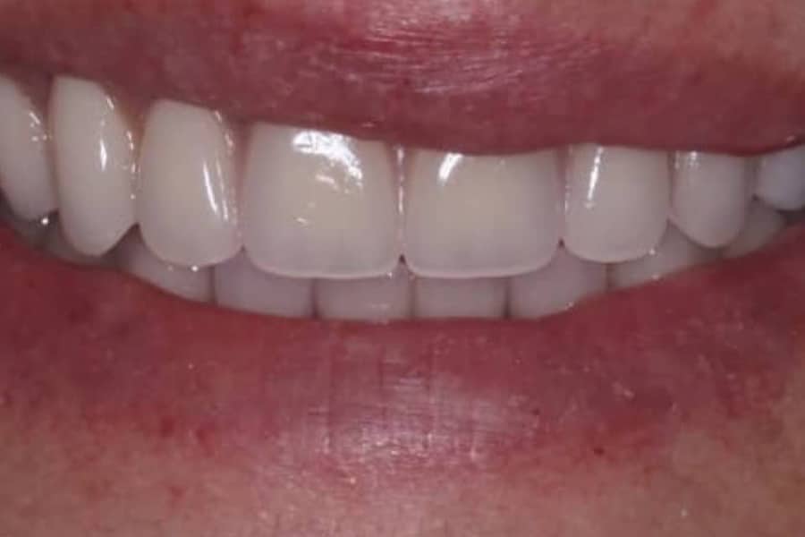After: Full smile restored at The Tooth Spa