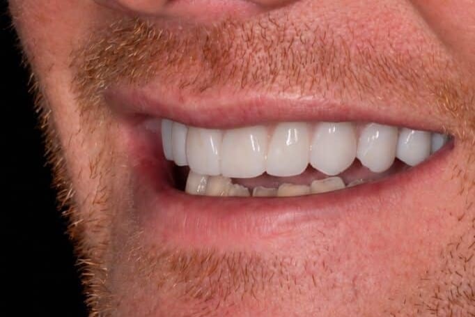 After: Gap filled at The Tooth Spa