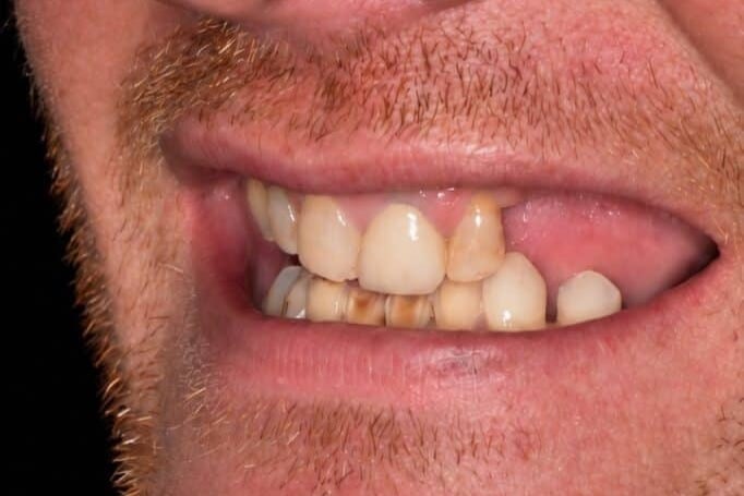 Before: Gap filled