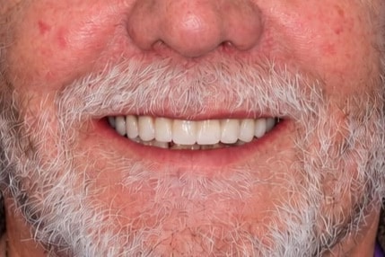 After: Smile rebuilt at The Tooth Spa
