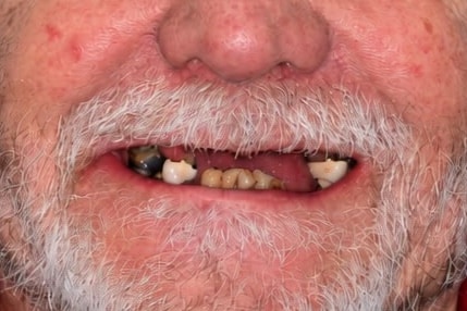 Before: Smile rebuilt