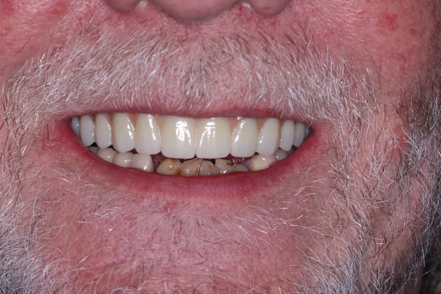 After: dental implants at The Tooth Spa, Leeds