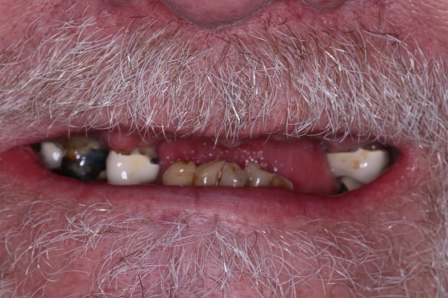 Before dental implants: broken and missing teeth