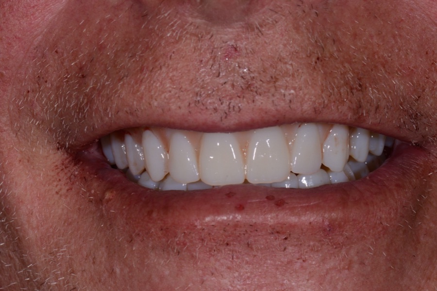 After: Missing teeth replaced with a complete smile at The Tooth Spa