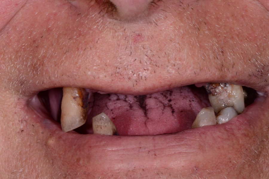 Before: Missing teeth replaced with a complete smile