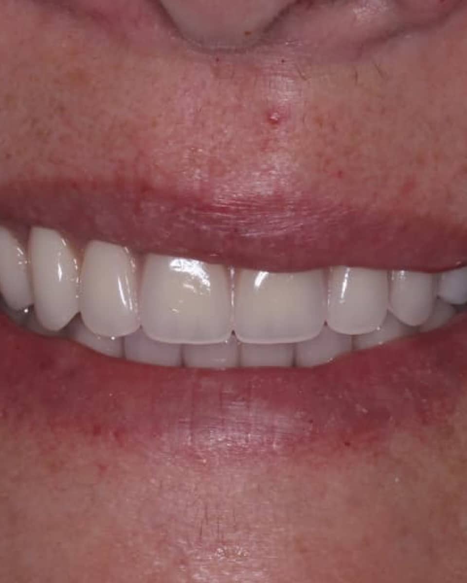 After: full smile at The Tooth Spa, Leeds