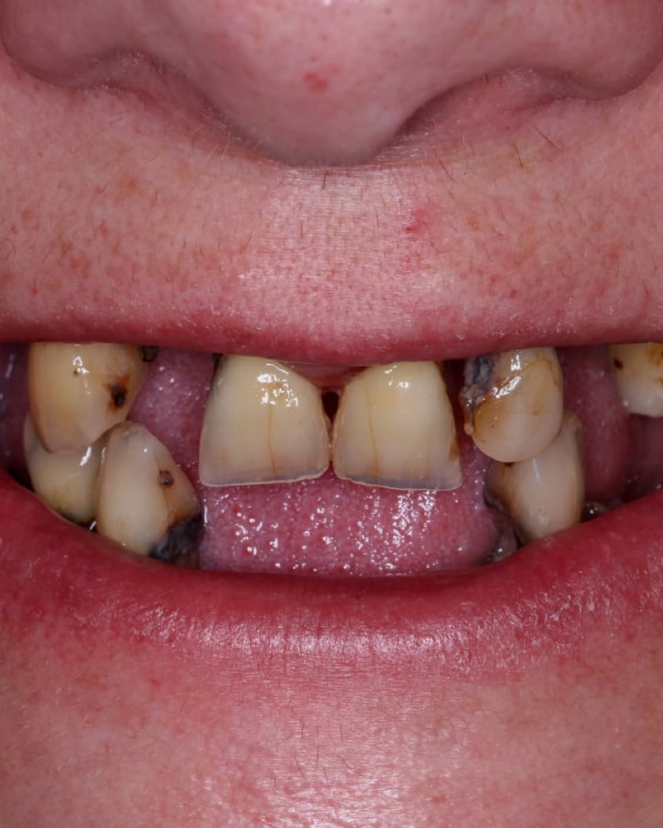 Before: worn and missing teeth, The Tooth Spa, Leeds
