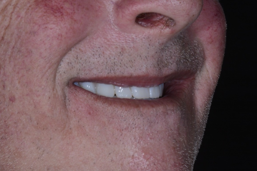 Smile restored with implants at The Tooth Spa, Leeds