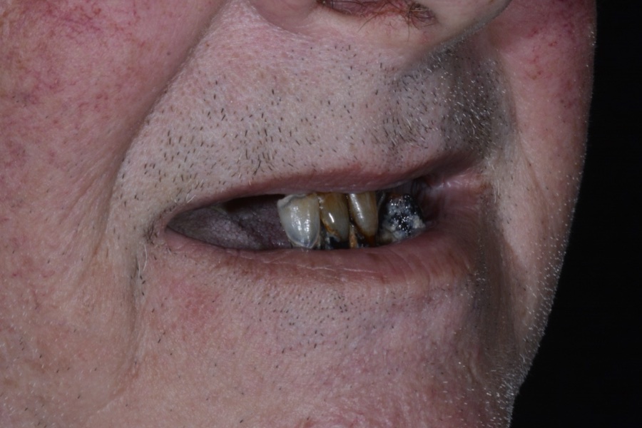 Missing and broken teeth before implant treatment