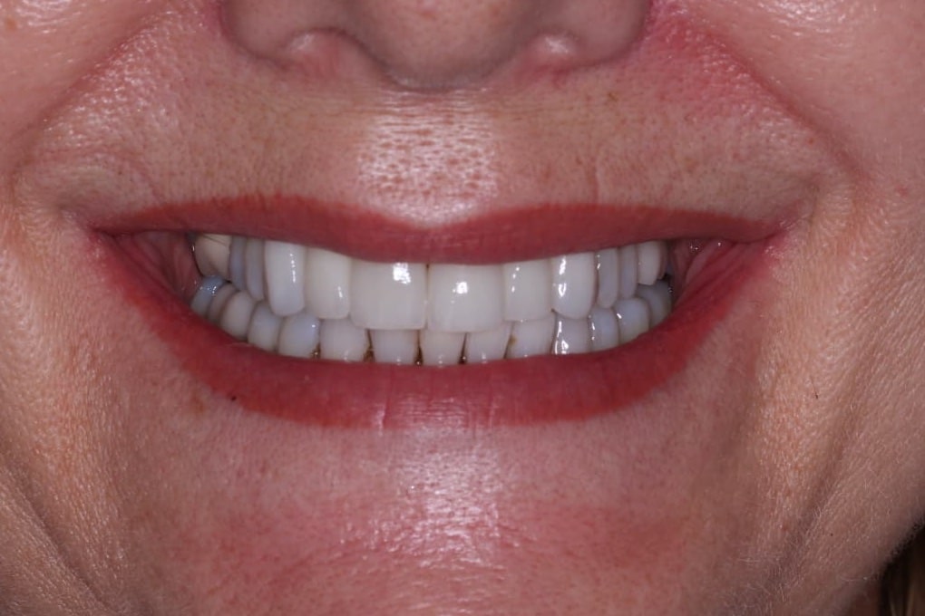 After: Gaps and worn teeth restored at The Tooth Spa