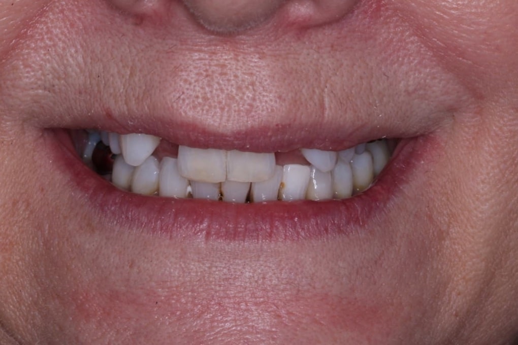 Before: Gaps and worn teeth restored
