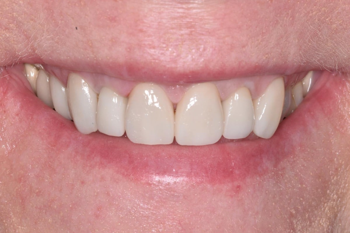 After: Veneers at The Tooth Spa