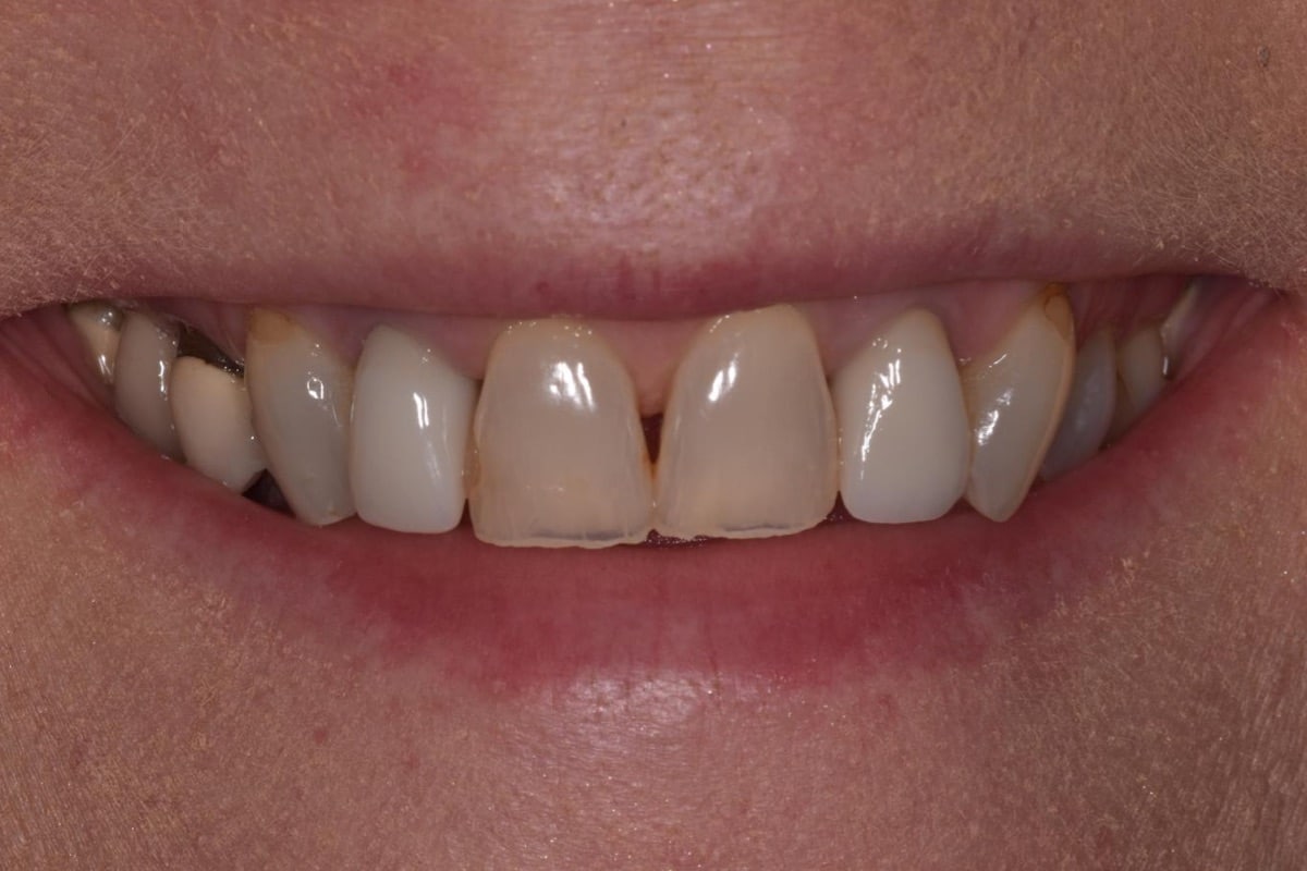 Before: Veneers